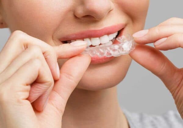 Invisalign (nakładki przezroczyste) — Pitshanger Clinic