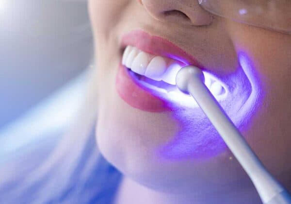 Wybielanie zębów — Pitshanger Clinic